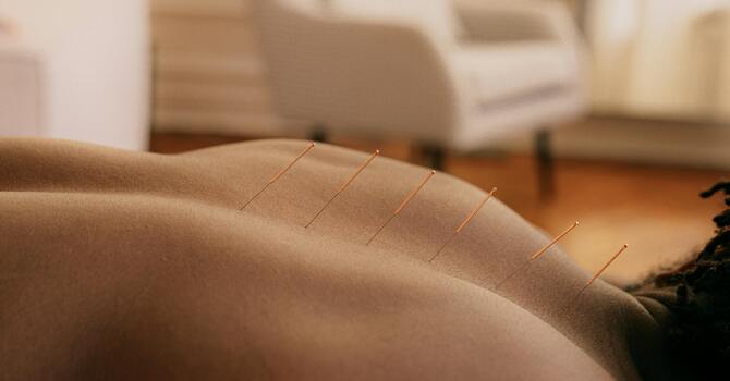 Acupuncture